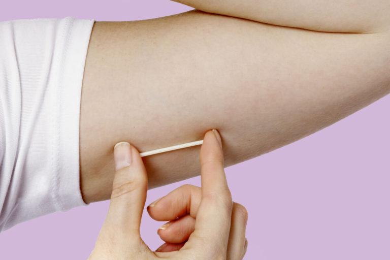 implant contraceptif