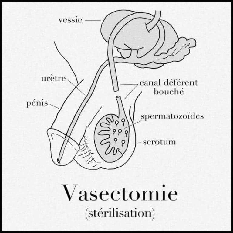 vasectomie