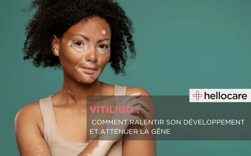 Vitiligo : causes, symptômes et traitements