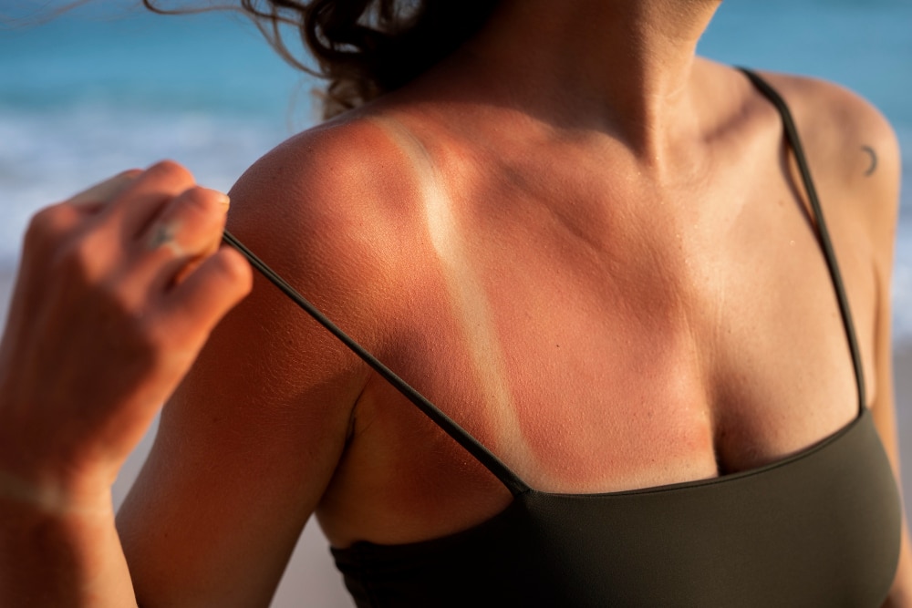 Coup de soleil : comment le soulager efficacement